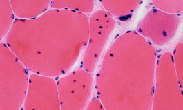Possibile terapia genica per la distrofia miotonica